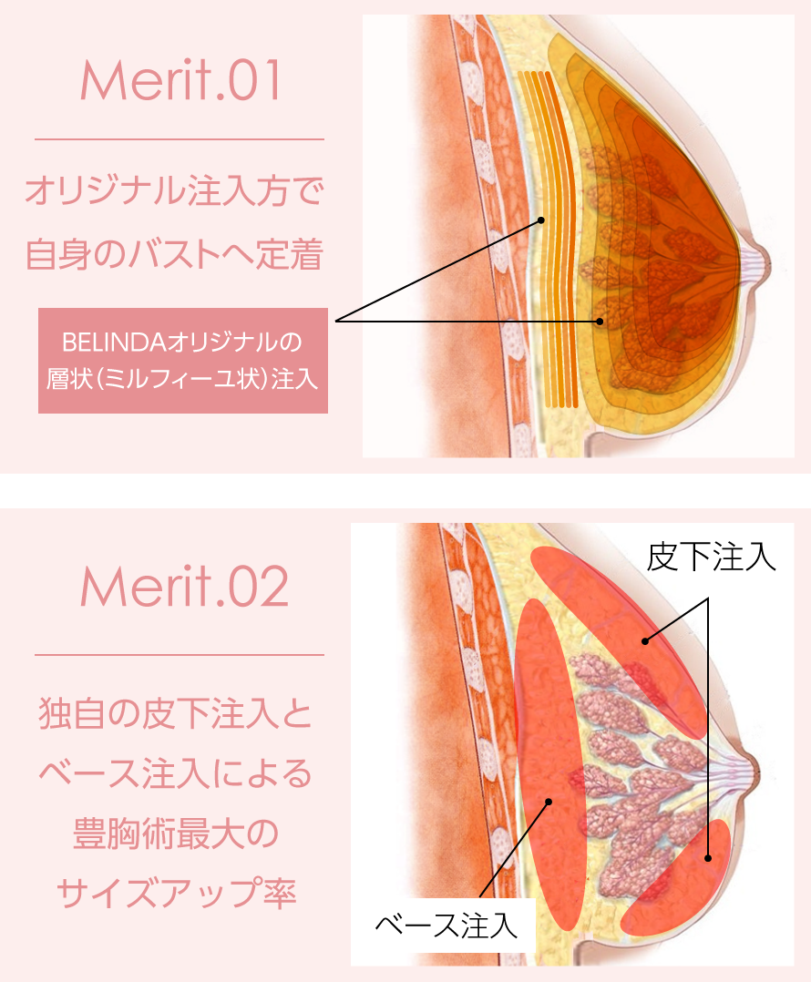 BELINDAの脂肪豊胸はオリジナル注入法で高い定着率を実現